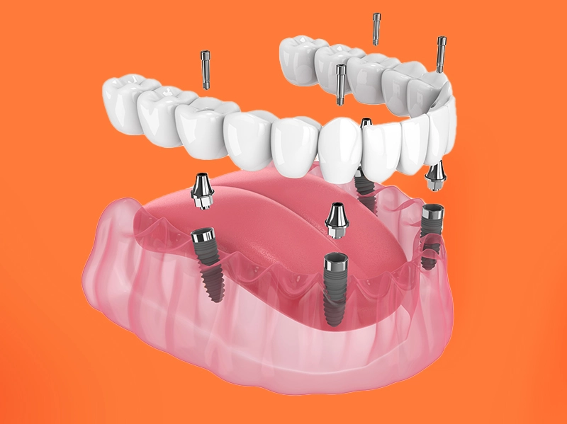 Thích hợp trồng răng Implant trong tất cả chỉ định lâm sàng
