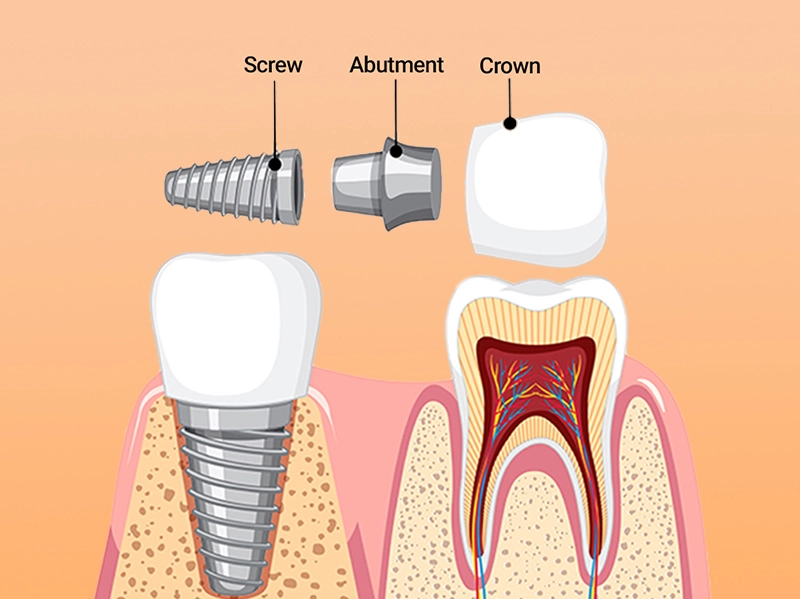 Trồng Răng Implant Là Gì?