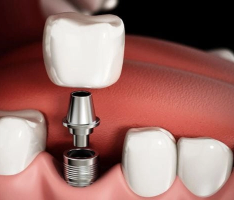 Trồng răng implant là gì? 4 điều cần biết trước khi cấy implant