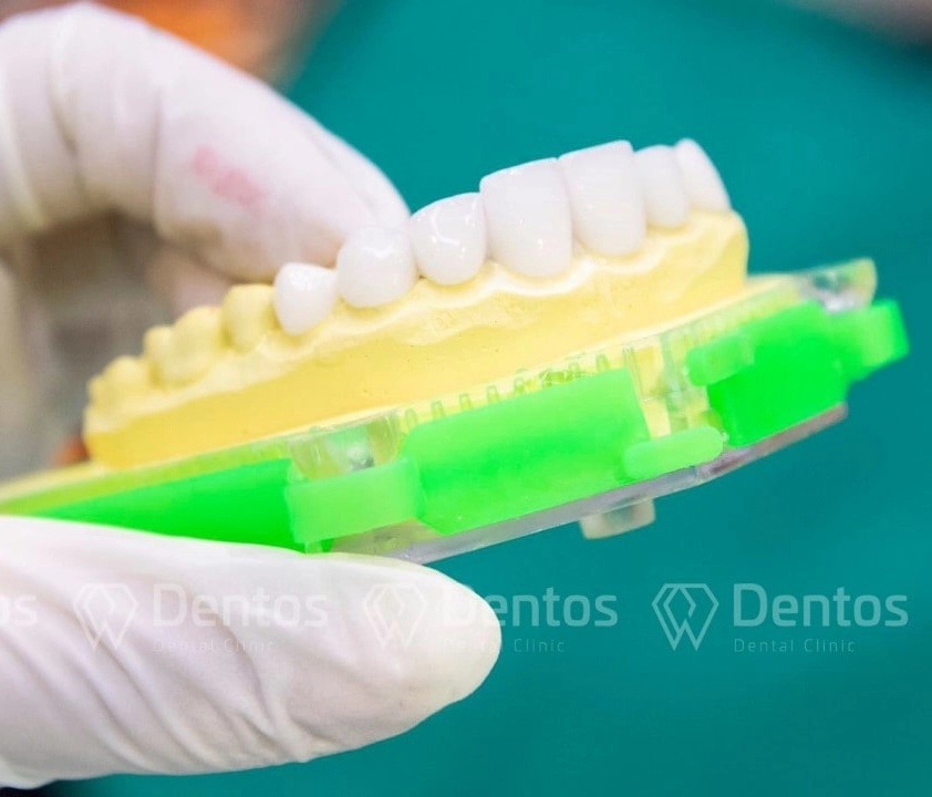 Tìm hiểu tất tật về bọc răng sứ thẩm mỹ
